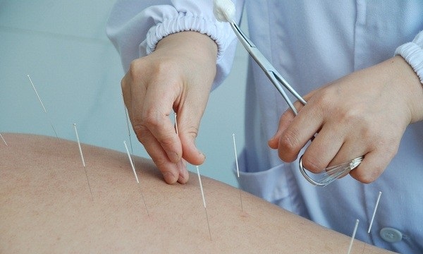 Acupuncture-photos-aks-tebe-zoozani-5