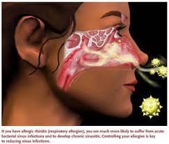 pollen-allergyg
