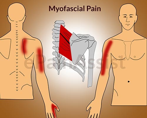 myofascial-pain