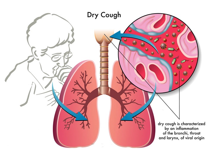 dry-cough