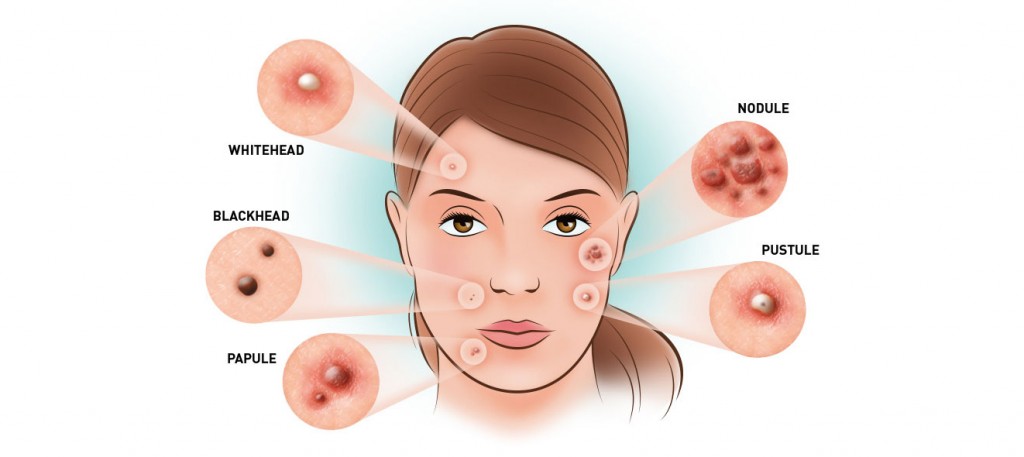 acne-types-for-how-to-get-rid-of-acne-fast